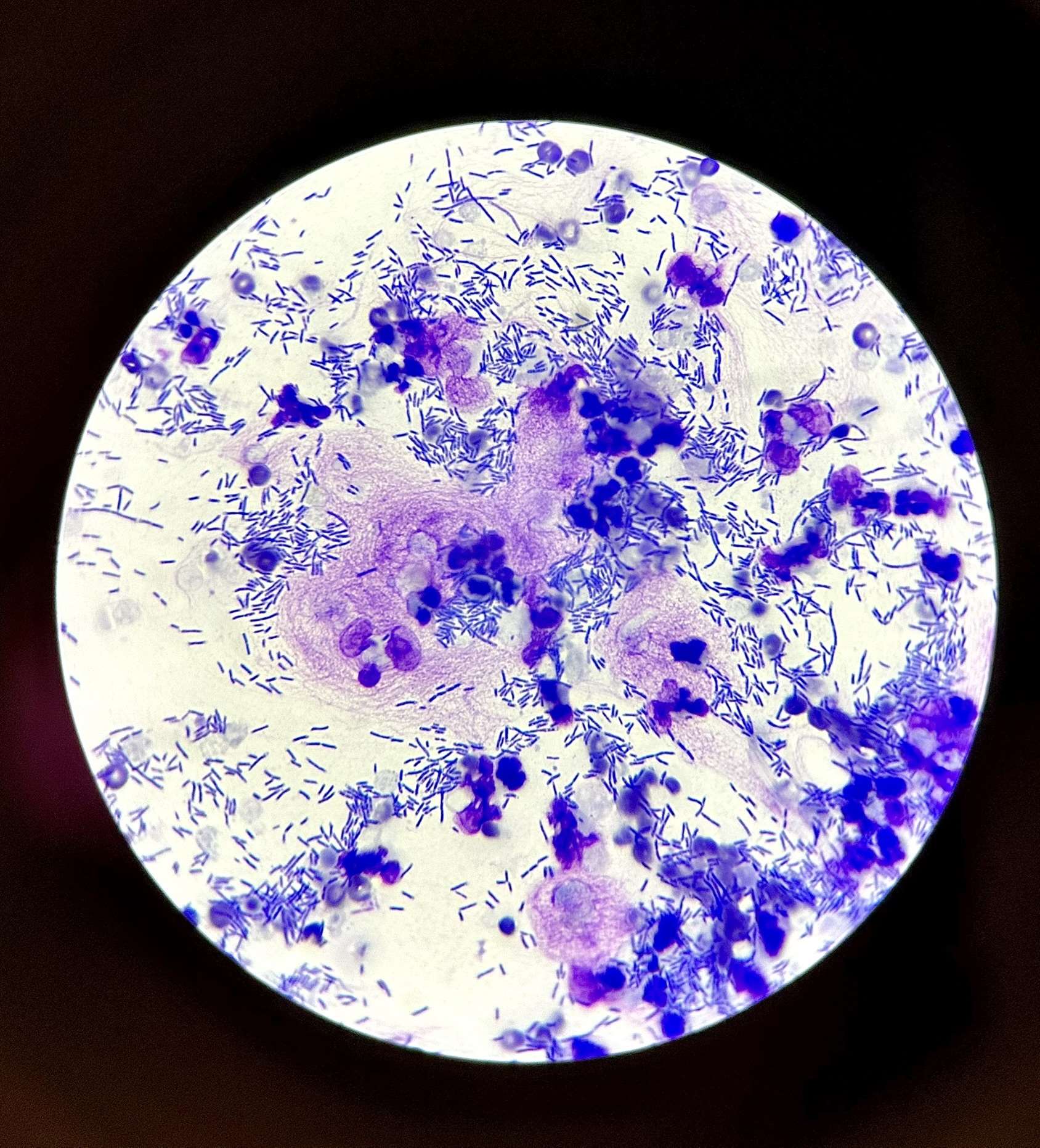 cystitis